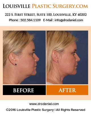 Facelift facts part 4 – frequently asked questions