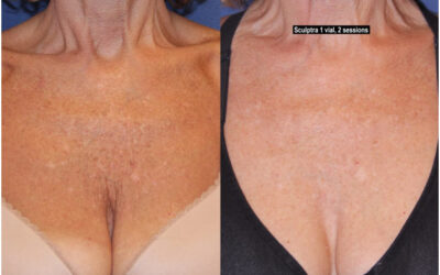 Are you self-Conscious about wearing halter tops, swimsuits, or low-Cut blouses due to chest wrinkles?