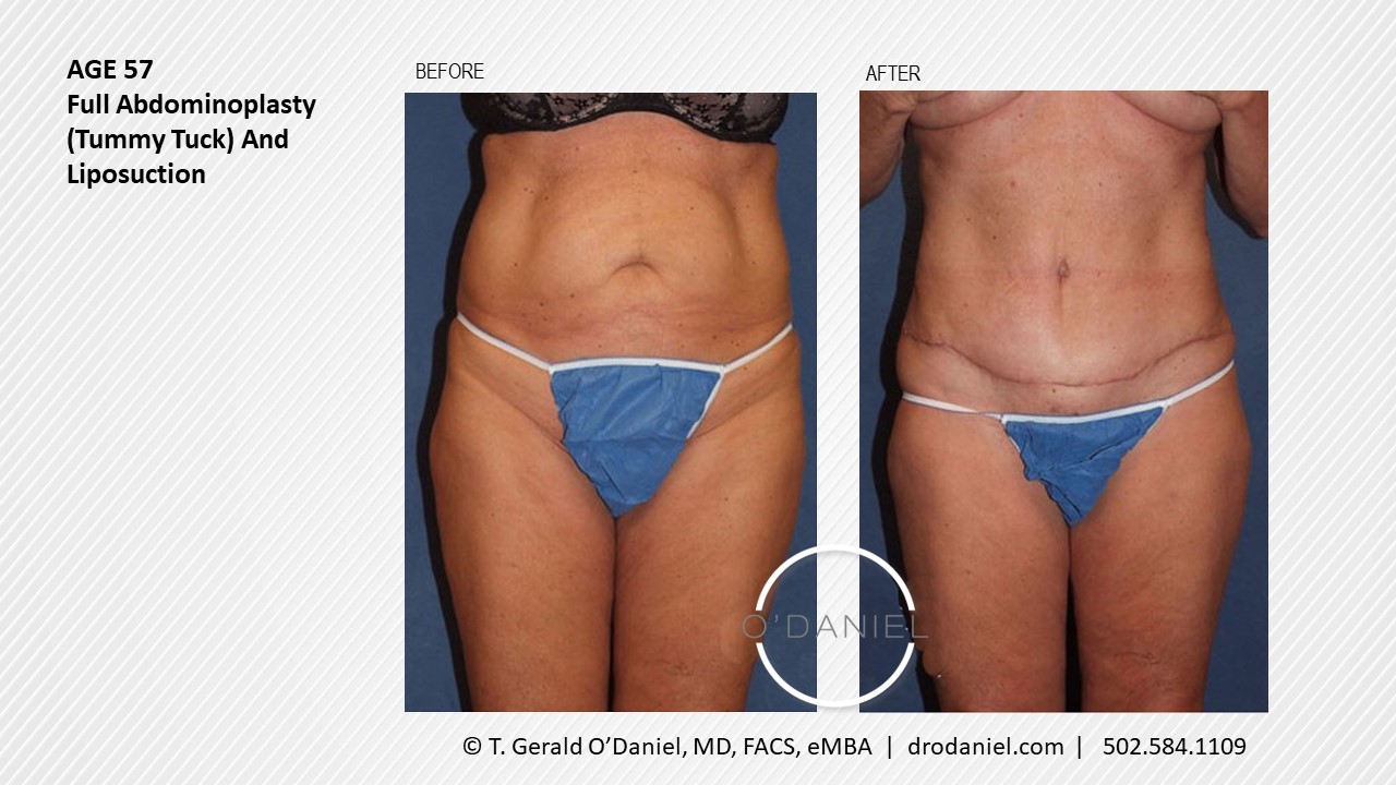 57-Year-Old-Full-Abdominoplasty-Tummy-Tuck-And-Liposuction-front-view