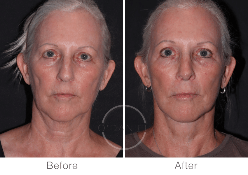 Frontal view of deep plane facelift and neck lift