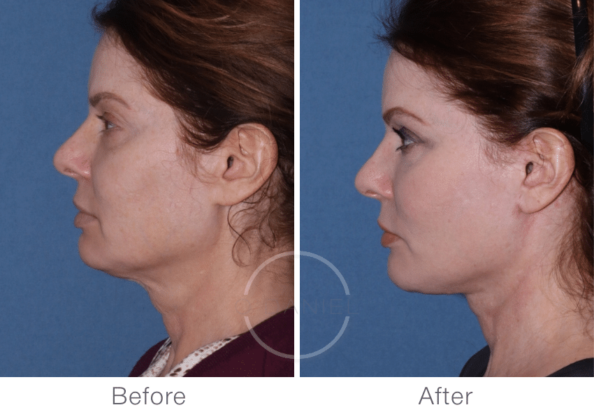 Lateral view of facelift before and after