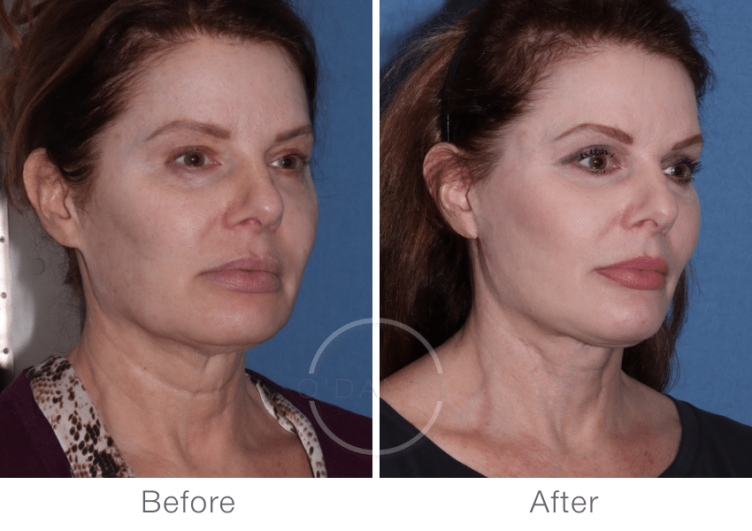 Oblique view of facelift before and after