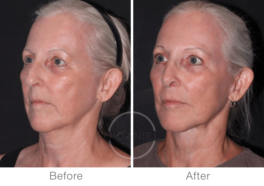Oblique view of deep plane facelift and neck lift