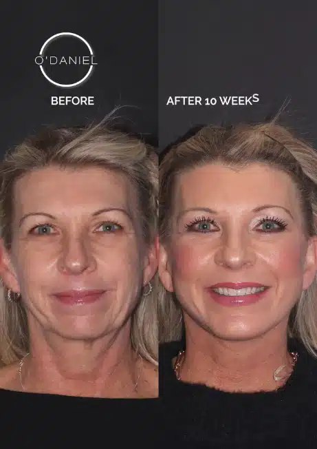 Deep Plane Facelift & Neck Lift With Chin Augmentation: A 5-Procedure Case Study at Age 53