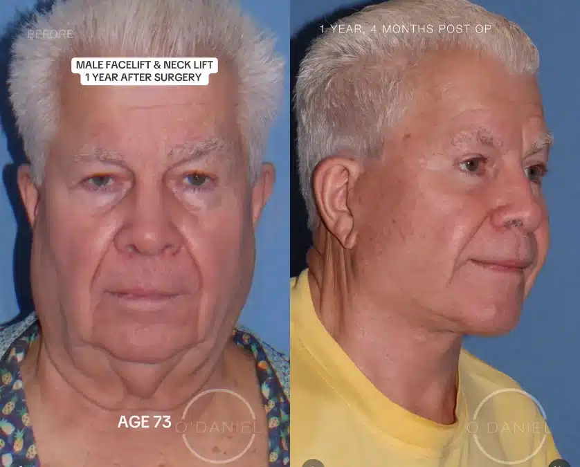 73 Years Old. Deep Plane Facelift. One Year Later. Here’s What That Actually Looks Like.